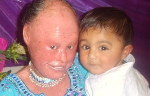 Meet the woman who’s in excruciating pain from her skin that grows 10 TIMES faster than normal