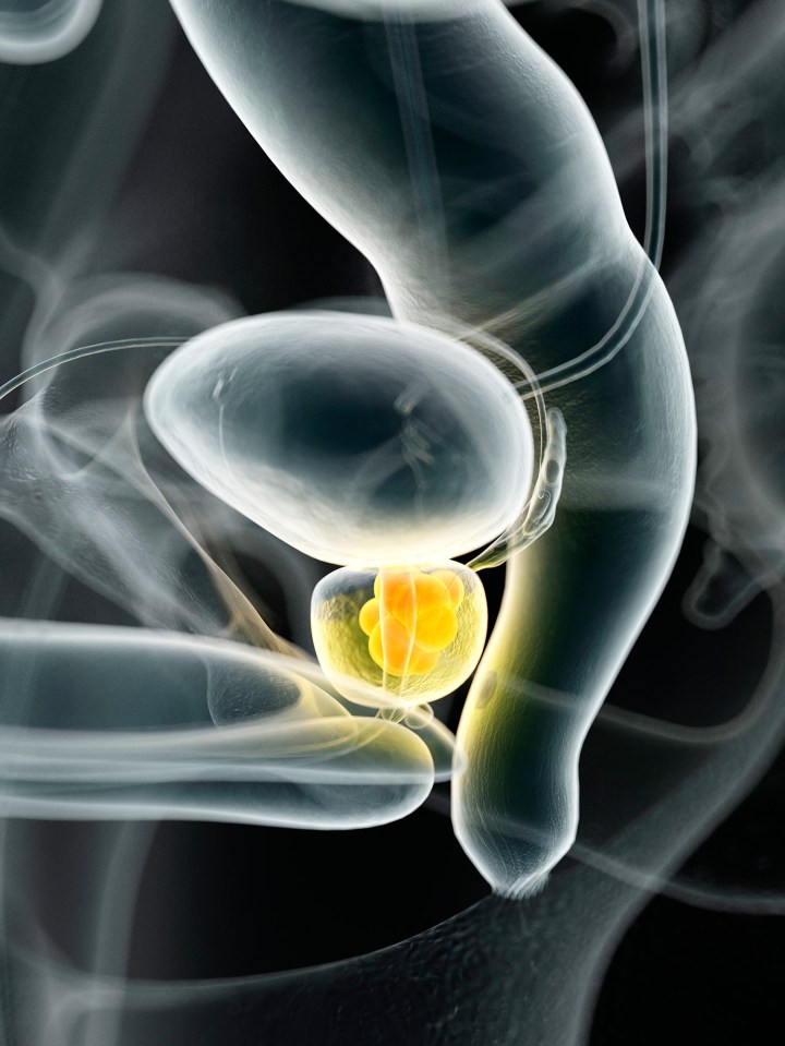 prostate cancer