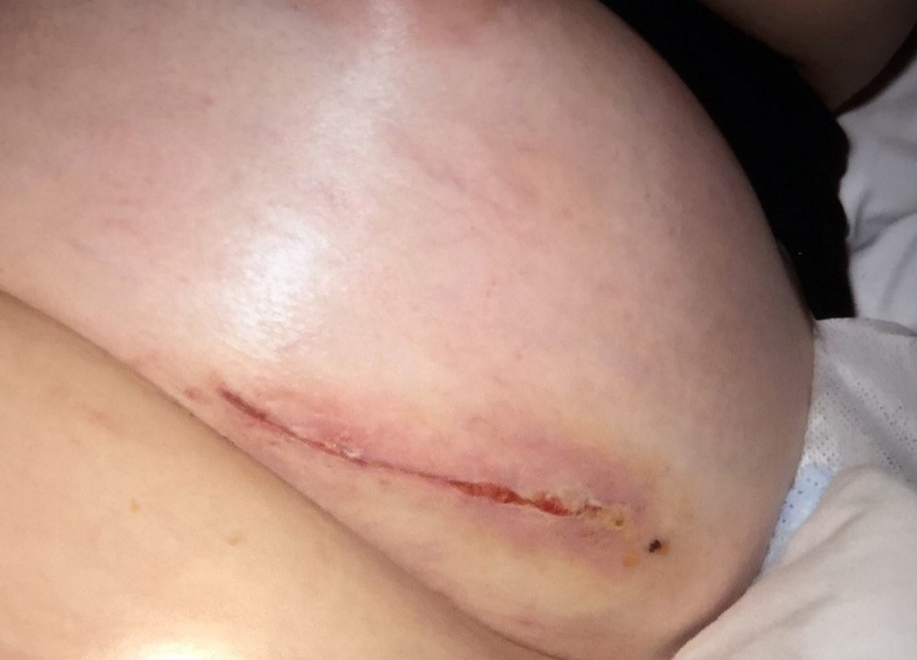 Delivery driver Dennie said the second op left her with a a "ripple" sensation in her left breast and when she took her bra off 'it just gushed out'