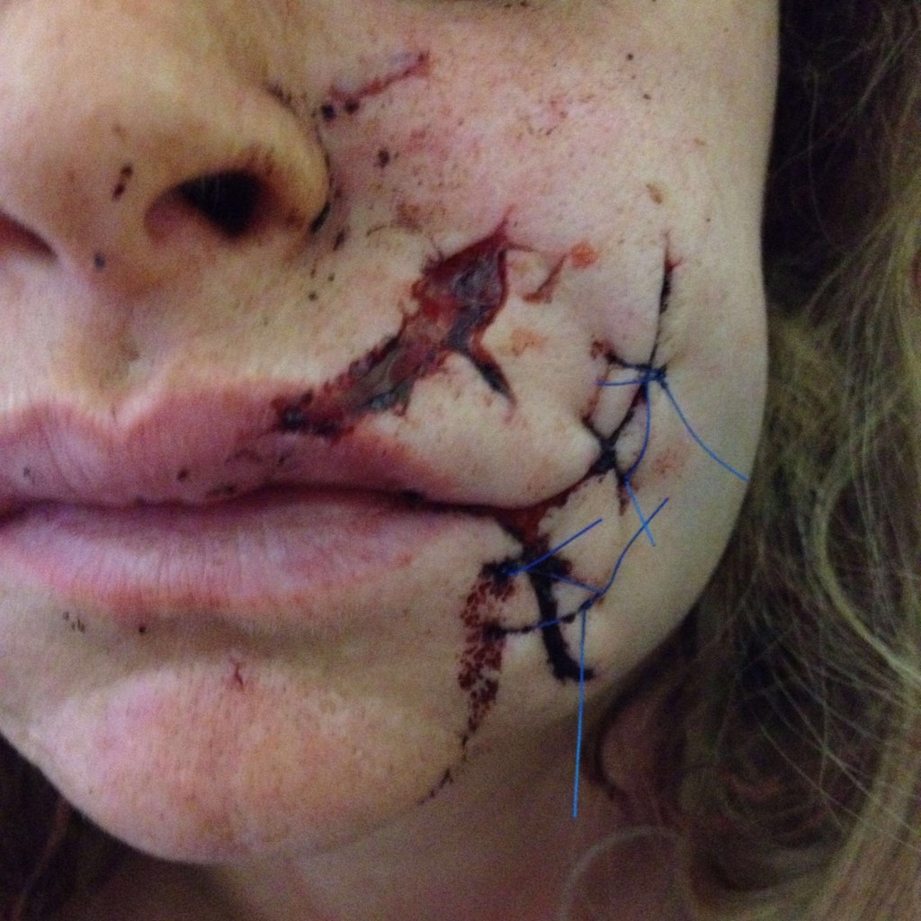 The mum-of-three spent three hours in surgery following the assault