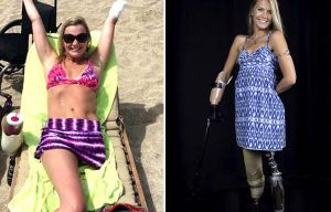 Girl who lost limbs to flesh-eating bug posts inspiring bikini snap