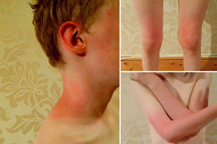 Charlie, 11, was COVERED in sunburn when he got home from a school picnic celebrating the Queen's 90th birthday