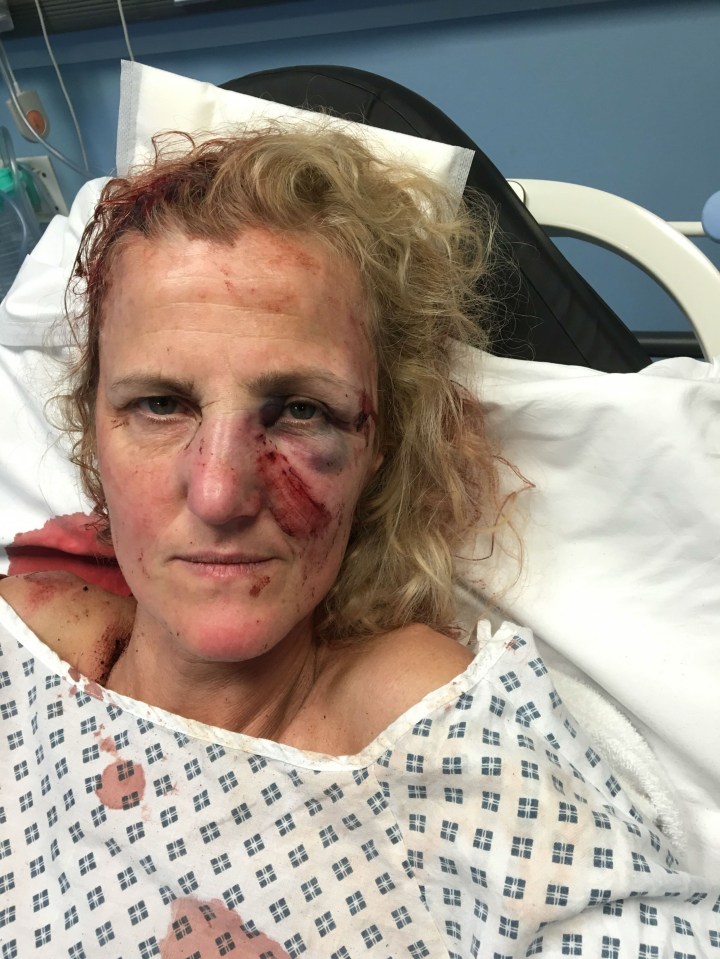 Melanie Robinson suffered two breaks to her nose, a black eye and swollen face