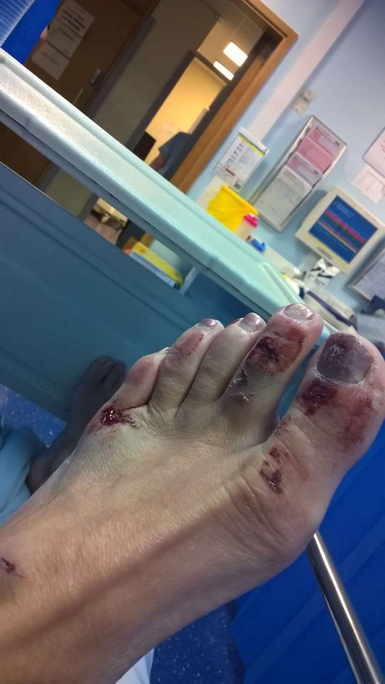 As well as a broken nose, black eye and swollen face, she is believed to have broken her toe too broken toe and finger too