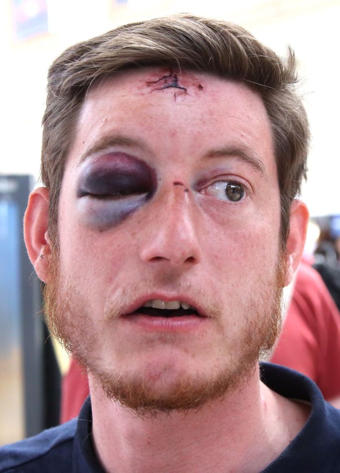 Martyn Lowe, 28, was left with a bulging eye after being bottled and punched unconscious by Russians.