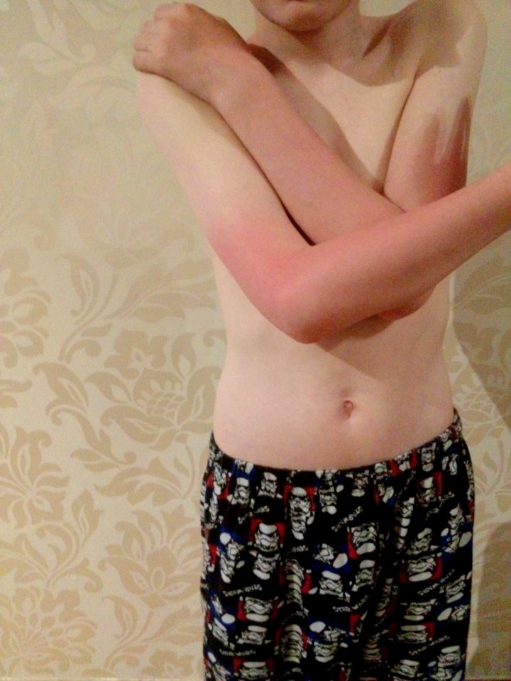 Both of the 11-year-old's arms were also scorched because he did not have sufficient sun lotion on at the picnic