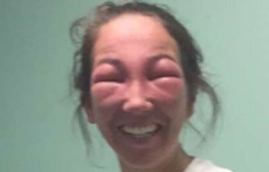 Poison ivy eyes