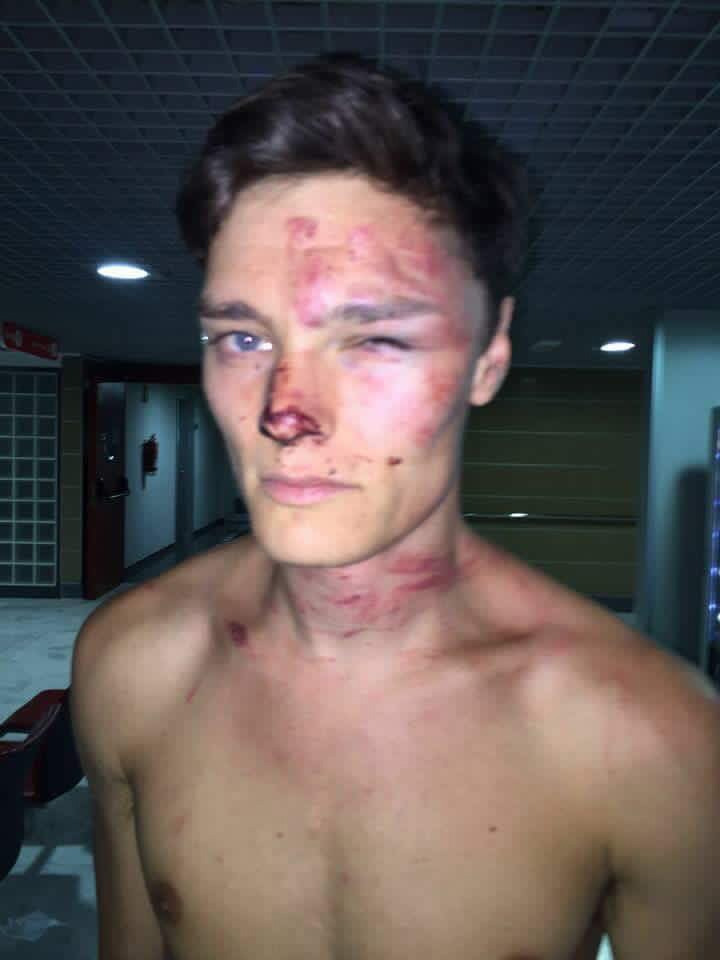 DJ Alex Henderson was battered by bouncers at the BH Mallorca hotel in Magaluf 