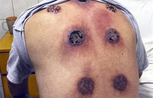 cupping