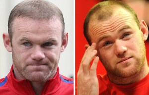 Has England captain Wayne Rooney secretly had botox on his forehead to reduce wrinkles?