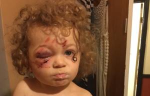 Tot suffers horrific injuries and may go BLIND in one eye after savage attack by crazed mutt