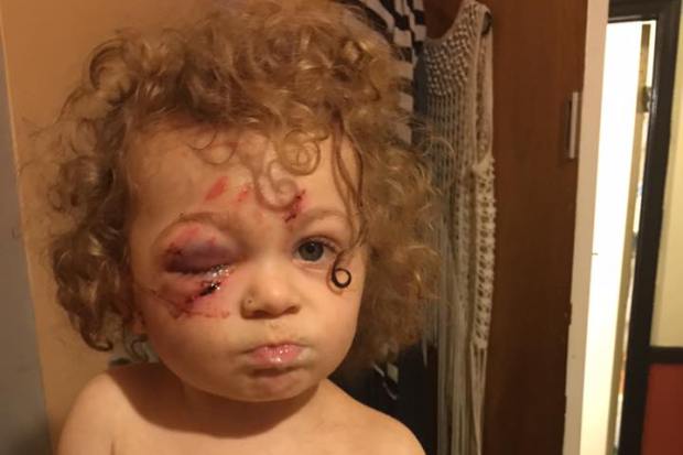 Bryson Moore pitbull attack