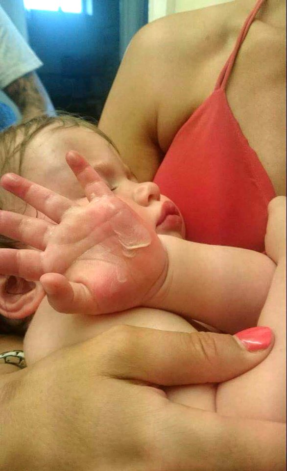 The youngster burned her hands on scalding hot metal playground bars