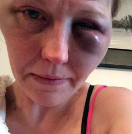 Ashley suffered horrific injuries when her boyfriend flew off the handle in an unprovoked attack