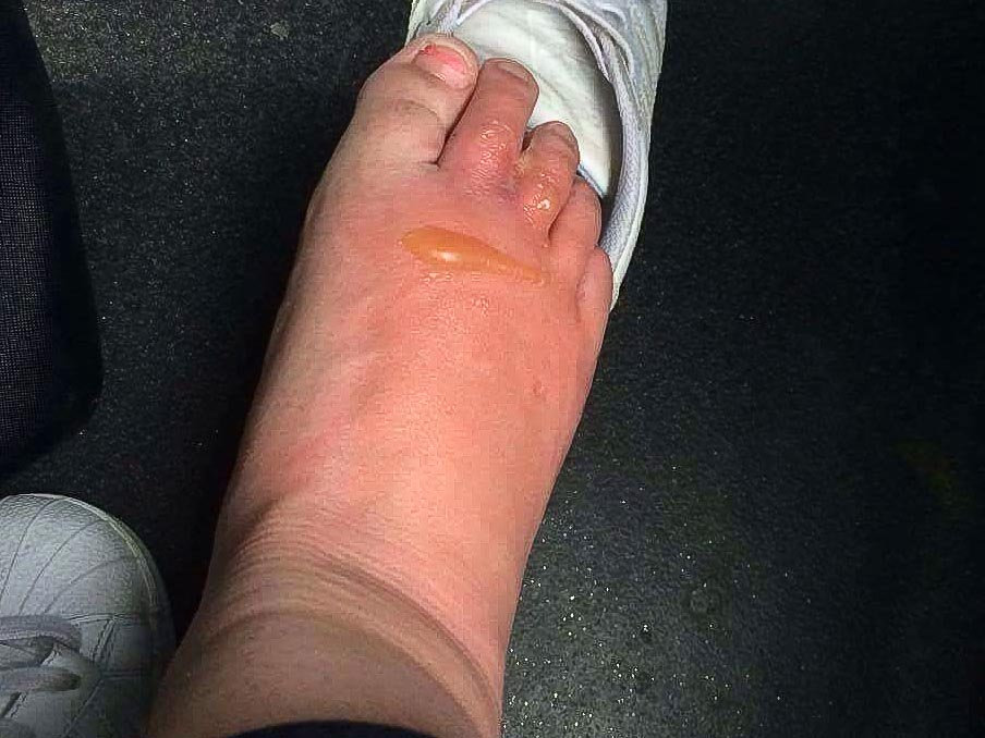 This is what Leah's foot looked like after she brushed against a toxic giant hogweed plant 