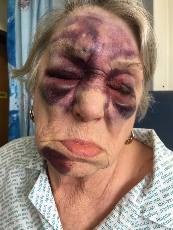 Jill's family has released the horrific picture of her facial injuries after she fell at a car home