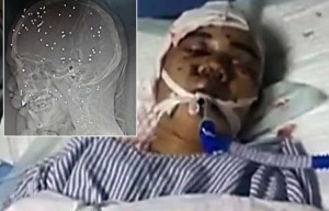 Man somehow survives shotgun blast which left EIGHTY pellets in his skull after being robbed by gang