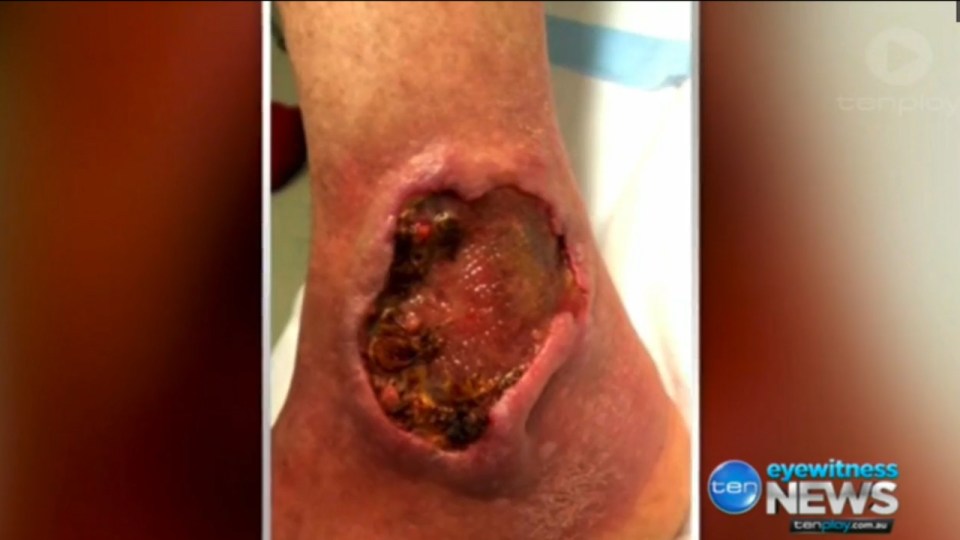 The horrific bug could be spreading across Australia