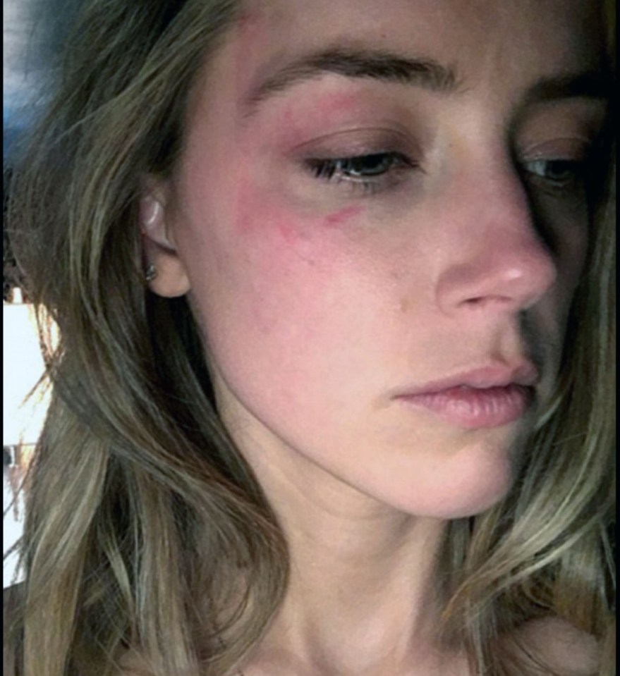 Amber claims Johnny smacked her in the face with an iPhone days before she filed for divorce