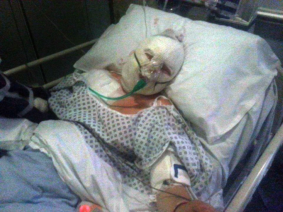 Kayleigh Hoggan is scarred for life after the blaze caused her third-degree burns