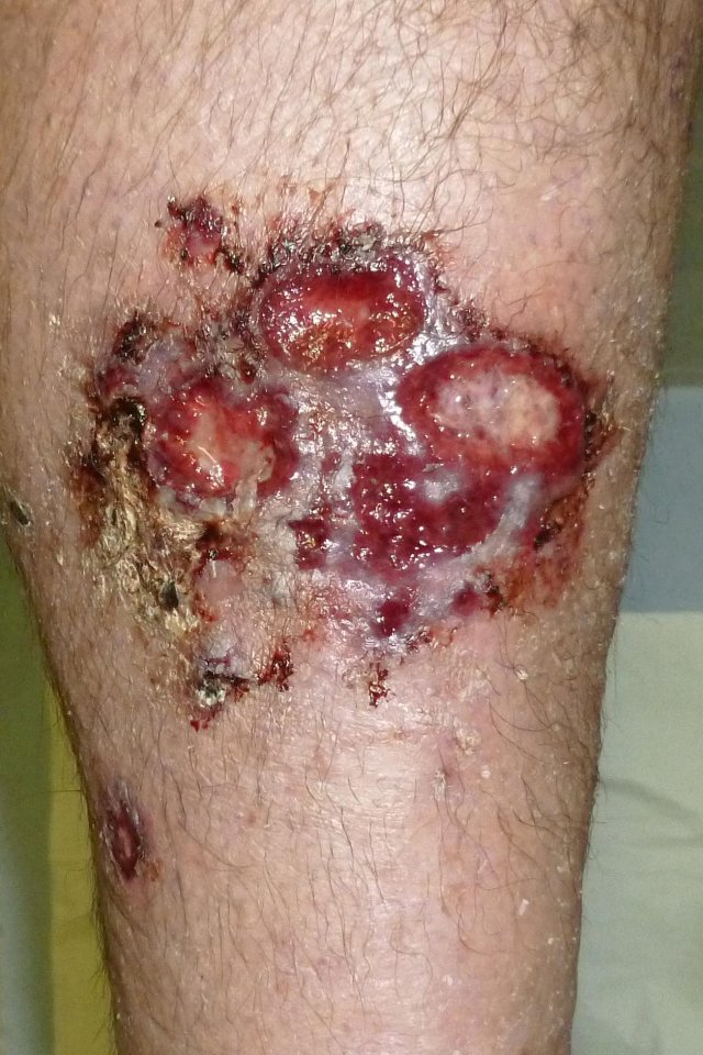 Within days his leg had swollen up to twice its normal size