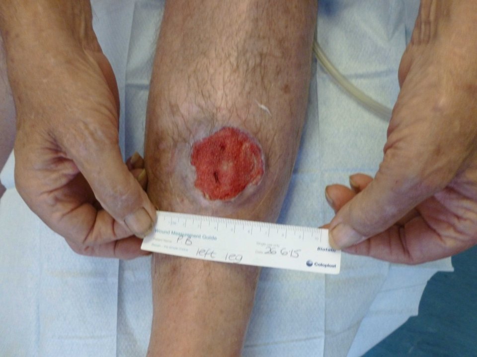 The granddad developed a massive ulcer that almost cost him his life