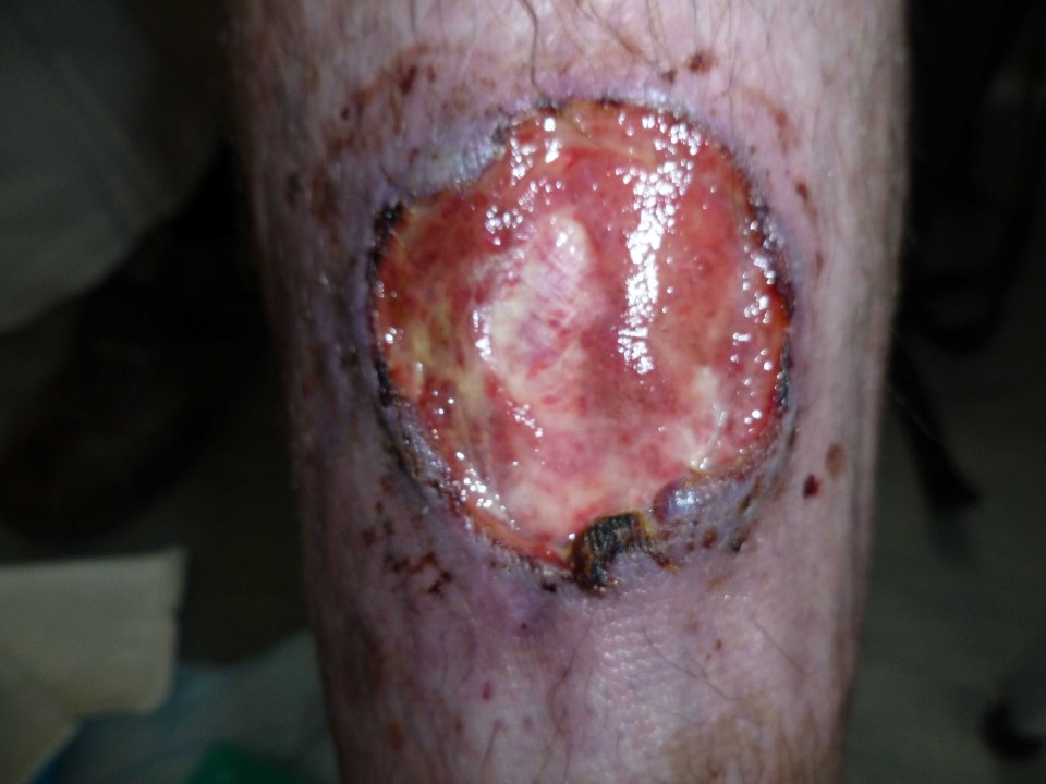 Peter had to get treatment for the wound for two years before it cleared up