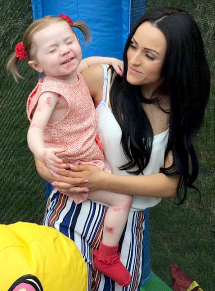 Those with the condition are known as "butterfly children" because they are so delicate to touch