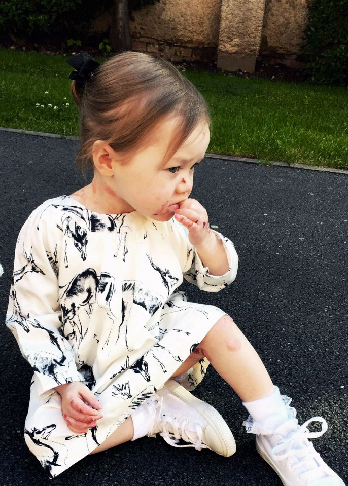 Little Isla's body turned into "one big blister" just hours after she was born