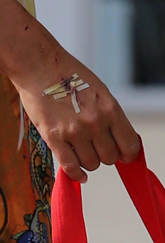 FAMEFLYNET - Exclusive: Karen Danczuk Seen With Cuts And Scrapes After Alleged Fight With Simon Danczuk In Spain