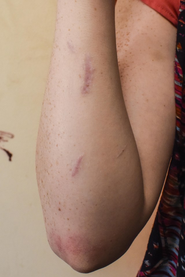 Chloe Parkes attacked by boyfriend