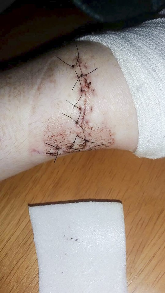 Chloe Parkes attacked by boyfriend