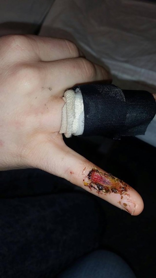 Chloe Parkes attacked by boyfriend