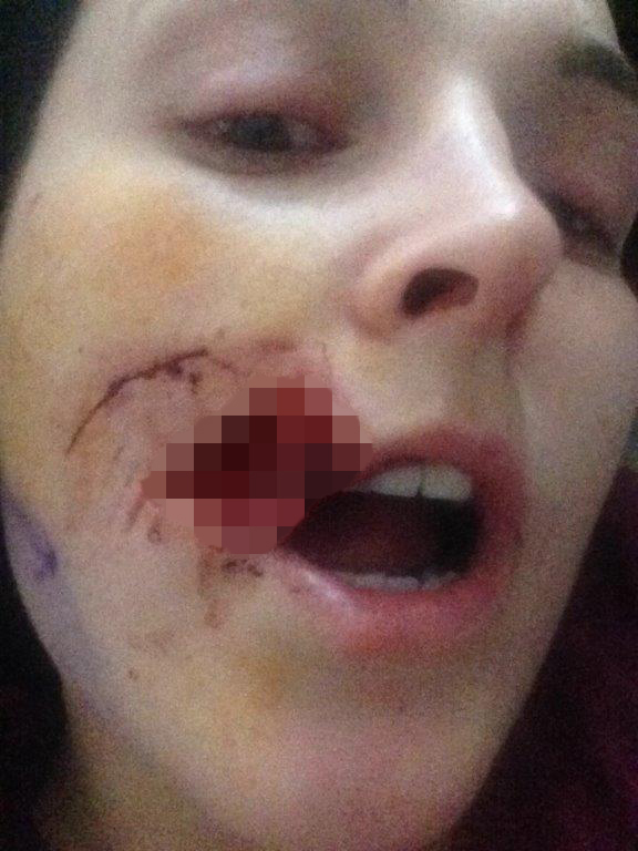 Kate Nield face bitten off