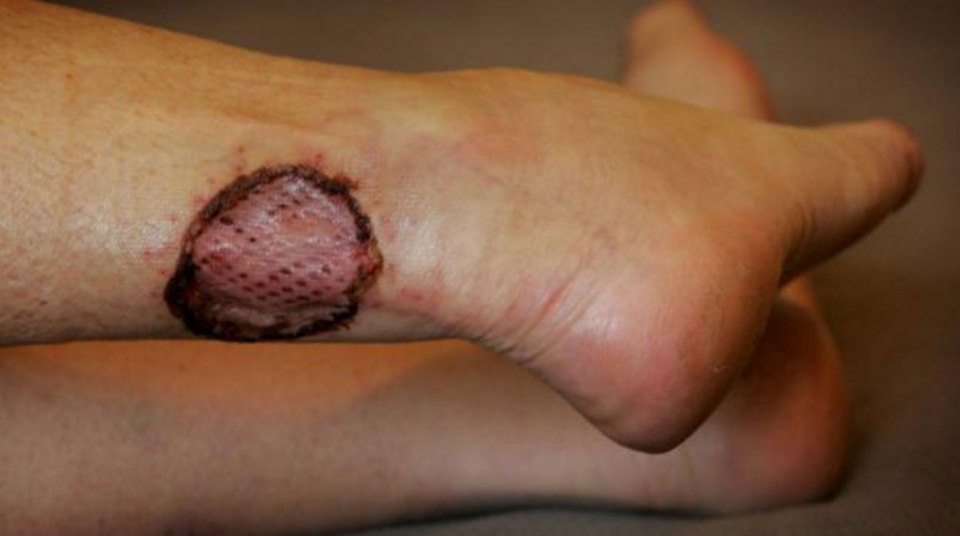 A woman fell victim to the flesh-eating bug on her ankle