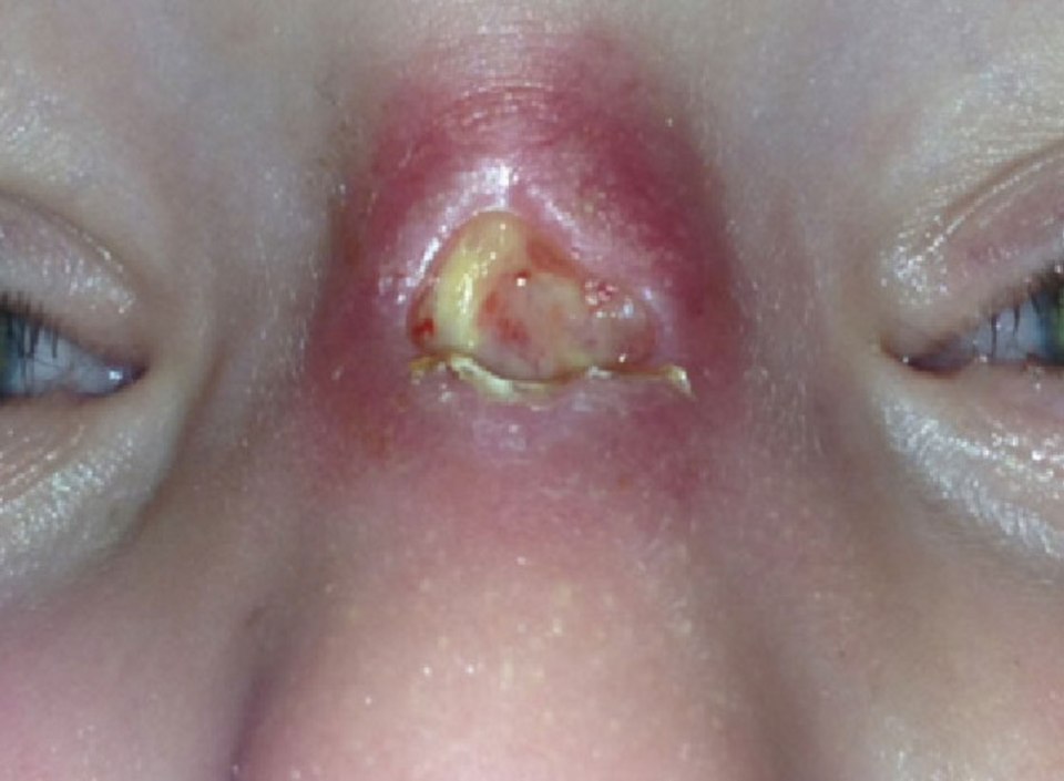 Toddler Sonny Hayes-Marshall had the bug living in his nose