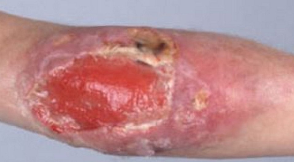 A nine-year-old girl contracted the Bairnsdale ulcer, with the bug going untreated 