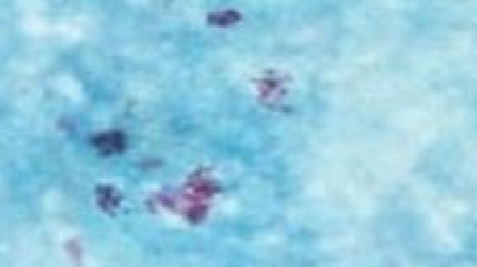 The Bairnsdale Ulcer under a microscope