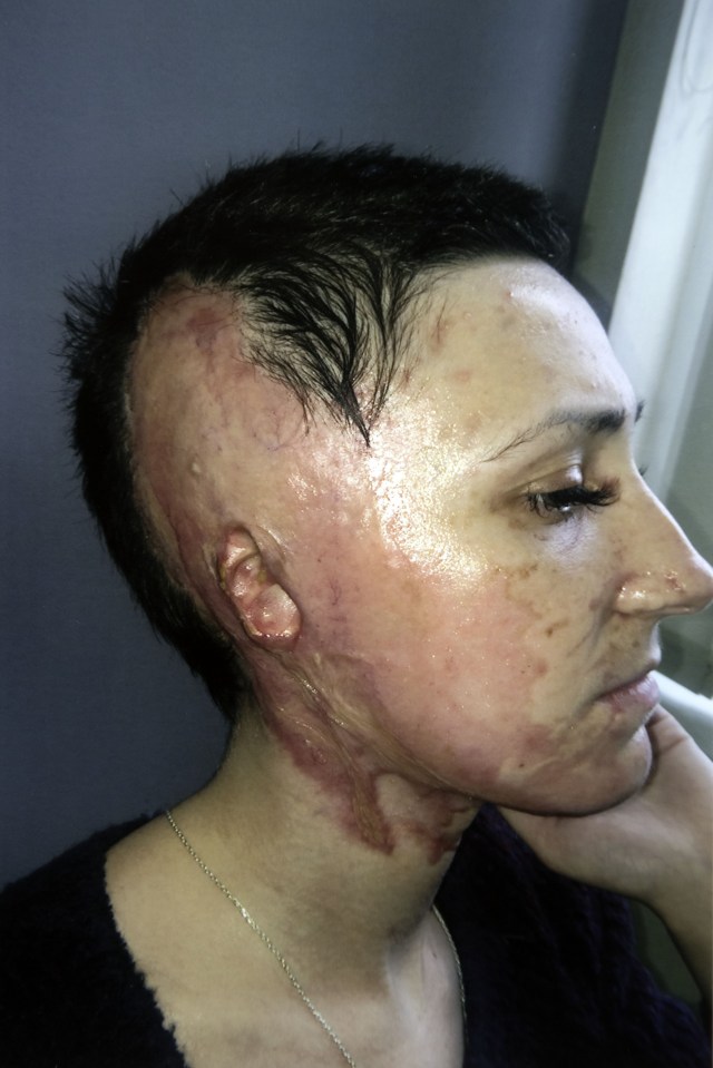 Adele has been left scarred for life - but says she accepted her changed appearance