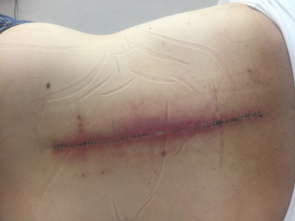 Rebecca Ruddy in hospital having back surgery (Collect - PA Real Life)