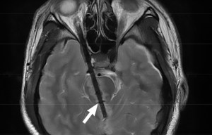 Doctors stunned to find man, 23, with 9cm CHOPSTICK in his brain following restaurant fight with brother