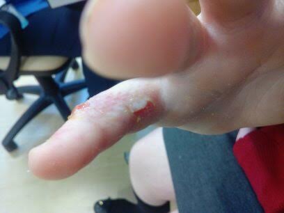 KFC burns