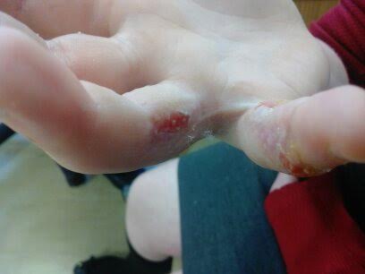 KFC burns