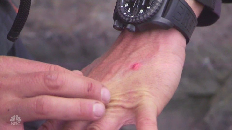 Bear shows off the jellyfish sting