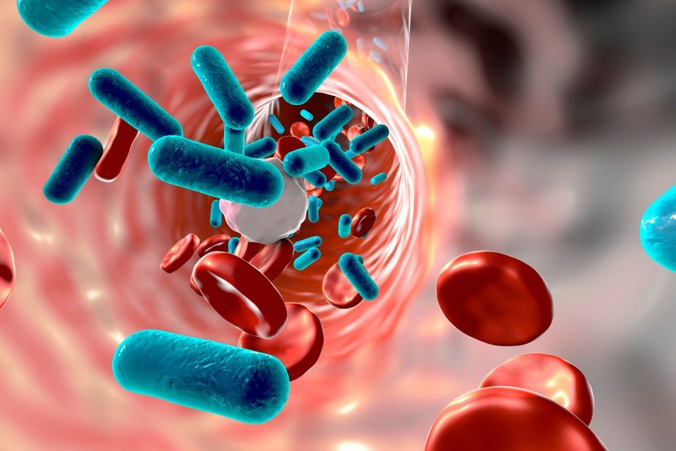  Sepsis, also known as blood poisoning, is a condition that is always triggered by another infection - be it a viral, bacterial, fungal or parasitic infection