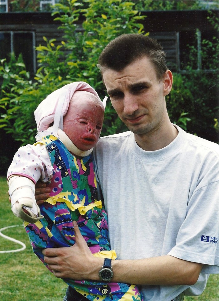 Terri was just 18 months old when she suffered 90 per cent burns in a fire started by her mum
