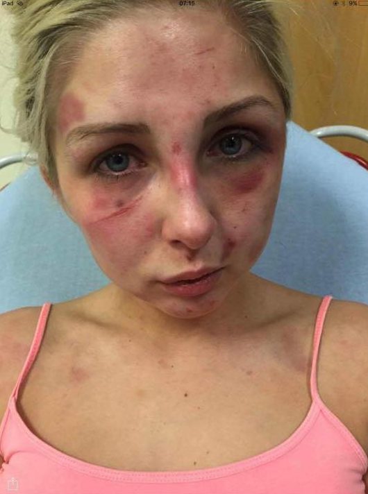 Kelsie Skillen shared photographs of her bruises after the vicious assault at the hands of her boyfriend