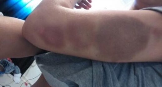 Bruises covered the arms of the teenager, who has since spoken out over the attack