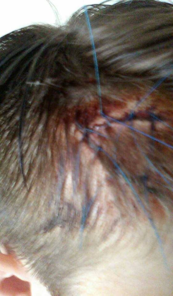 Owen needed six stitches after the attack, with the young man saying he had never seen a clown in the area before the Wednesday night attack