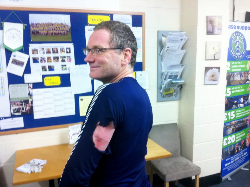 Hanno Nickau suffered a painful burn when a yob hurled a firework at him from a passing car as he went for a run
